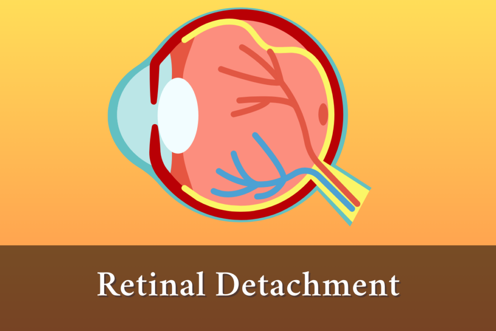Understanding Retinal Detachment