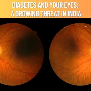 Blog 47 Diabetes and Eye Health: An Increasing Concern in India