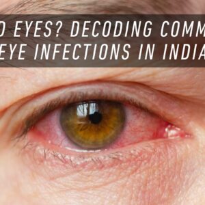 Blog 49 Understanding Red Eyes: Common Eye Infections in India (circa 2025)